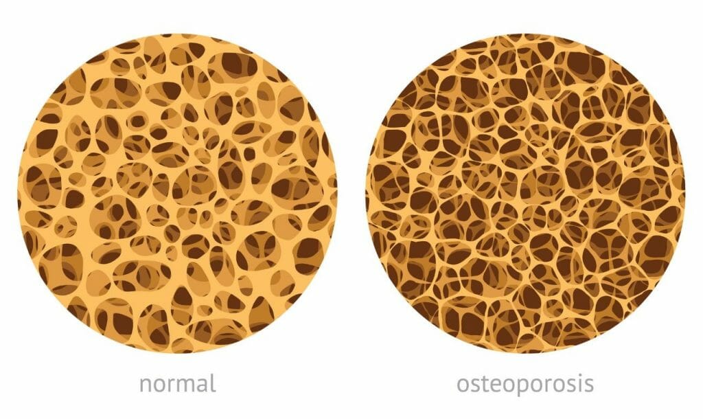 effects of aging on bones